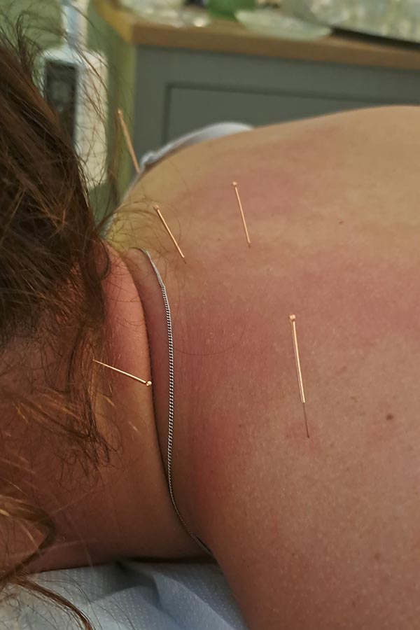 Acupuncture Acupuncture