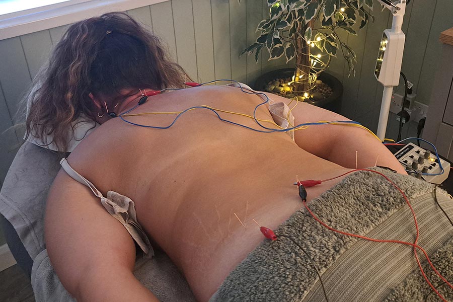 Acupuncture Acupuncture